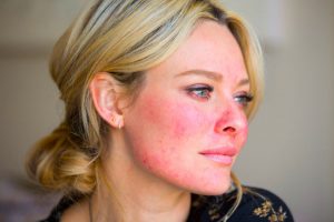 How to Cover Up Rosacea
