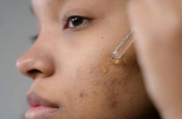 Say Goodbye to Acne Scars With These Products