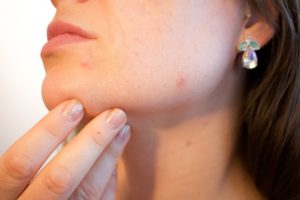 How to Minimise Your Acne Scars